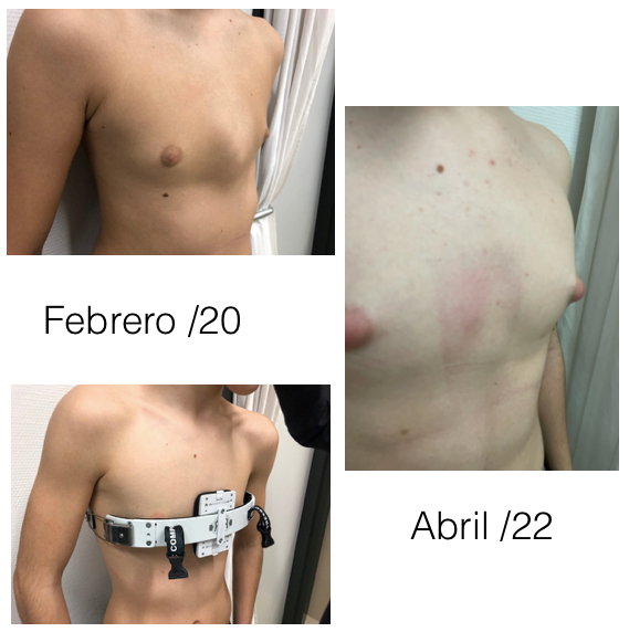 Radiografía y material quirúrgico de fijación torácica